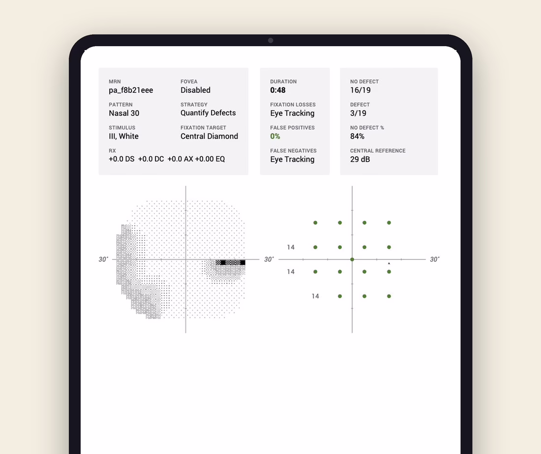 nasal 30 visual field screener